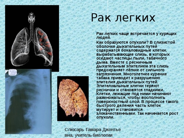 Рак легких  Рак легких чаще встречается у курящих людей.  Как образуются опухоли? В слизистой оболочке дыхательных путей содержатся бокаловидные клетки, вырабатывающие слизь, в которых оседают частицы пыли, табачного дыма. Вместе с ресничным дыхательным эпителием эта слизь предохраняет лёгкие от сильного загрязнения. Многолетнее курение табака приводит к разрушению эпителия дыхательных путей. Эпителиальные клетки теряют реснички и становятся гладкими. Клетки, лежащие под ними начинают размножаться, чтобы восполнить поверхностный слой. В процессе такого быстрого деления часть клеток мутирует и становится злокачественными. Так начинается рост опухоли.