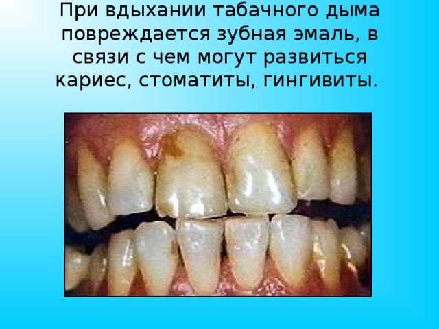 При вдыхании табачного дыма повреждается зубная эмаль, в связи с чем могут развиться кариес, стоматиты, гингивиты.