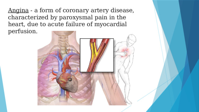 Angina - a form of coronary artery disease, characterized by paroxysmal pain in the heart, due to acute failure of myocardial perfusion.