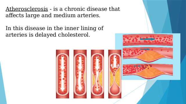 Atherosclerosis - is a chronic disease that affects large and medium arteries. In this disease in the inner lining of arteries is delayed cholesterol.