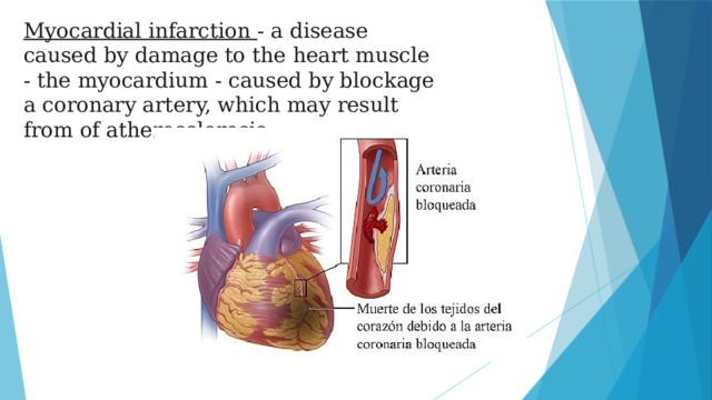 Myocardial infarction - a disease caused by damage to the heart muscle - the myocardium - caused by blockage a coronary artery, which may result from of atherosclerosis.