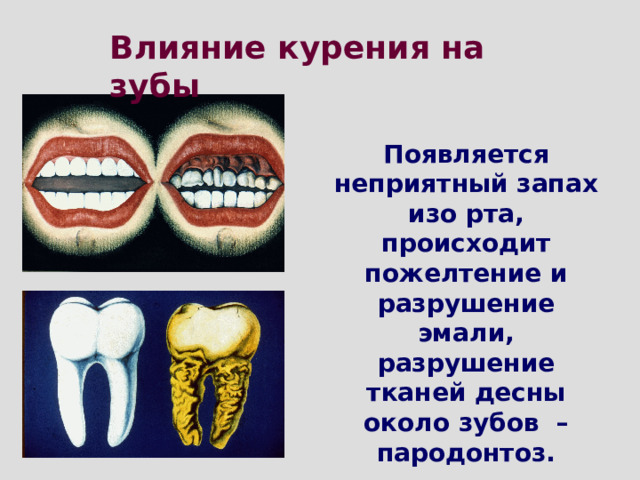 Влияние курения на зубы Появляется неприятный запах изо рта, происходит пожелтение и разрушение эмали, разрушение тканей десны около зубов –пародонтоз.