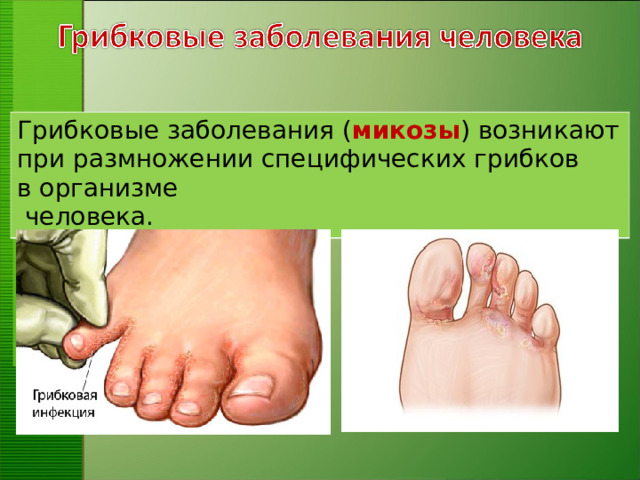 Грибковые заболевания ( микозы ) возникают при размножении специфических грибков в организме  человека.